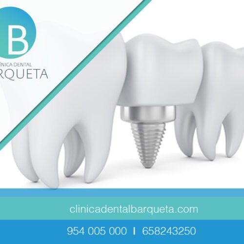 Implante dental en Sevilla. Clínica dental Barqueta