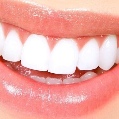 ¿Qué es mejor el blanqueamiento dental o carillas?