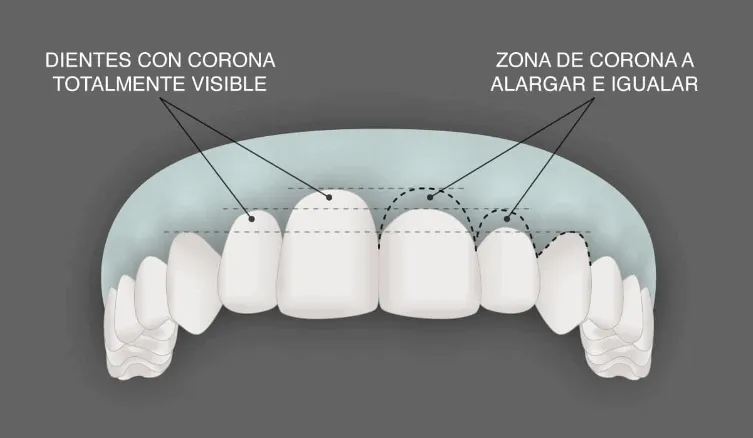 corona encias clinica dental barqueta