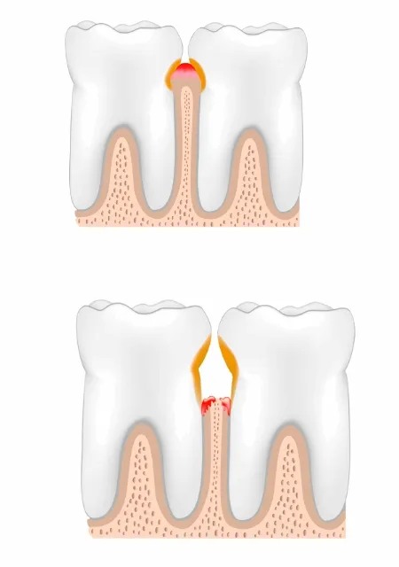 gingivitis encias dientes clinica dental barqueta