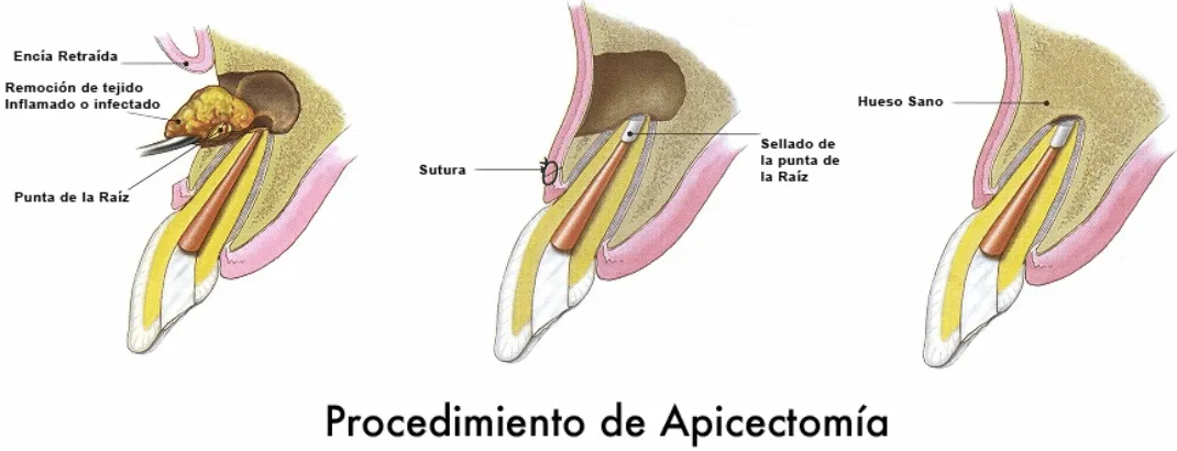 procedimiento apicectomia clinica dental barqueta