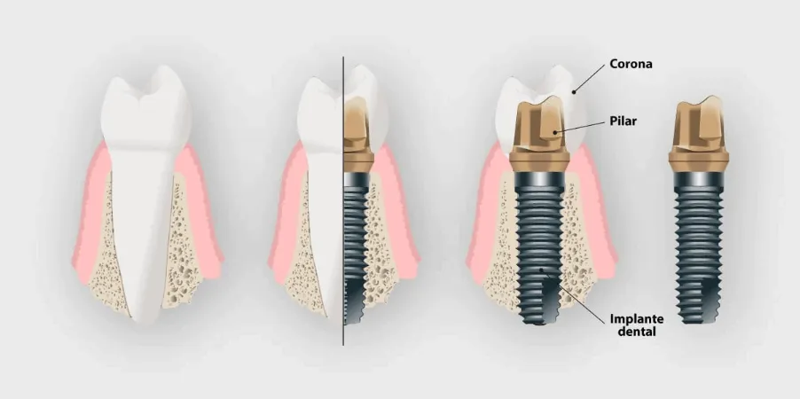 dientes implantes dentales clinica dental barqueta