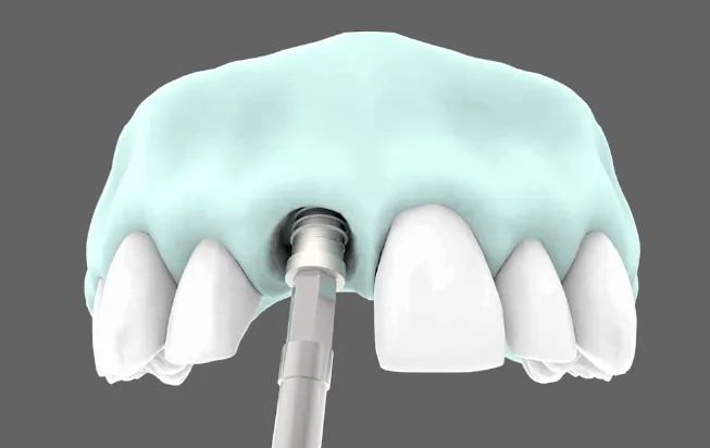 dudas frecuentes implantes dentales clinica dental barqueta