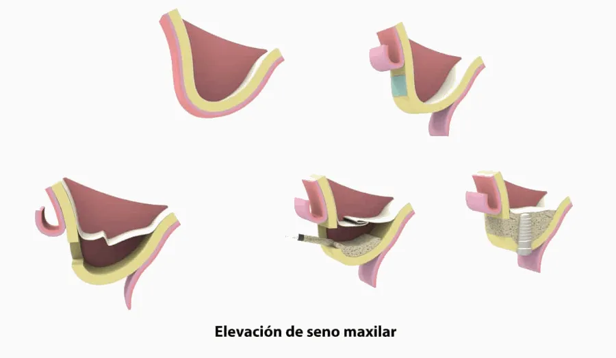 elevacion seno maxilar clinica dental barqueta