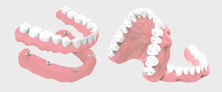 limpieza implantes dentales clinica dental barqueta