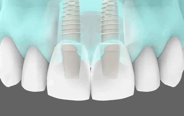 preguntas frecuentes implantes dentales clinica dental barqueta