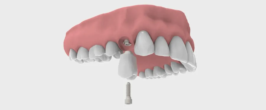 protesis dientes implantes dentales clinica dental barqueta